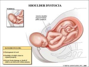 shoulder-dystocia-yellow_434